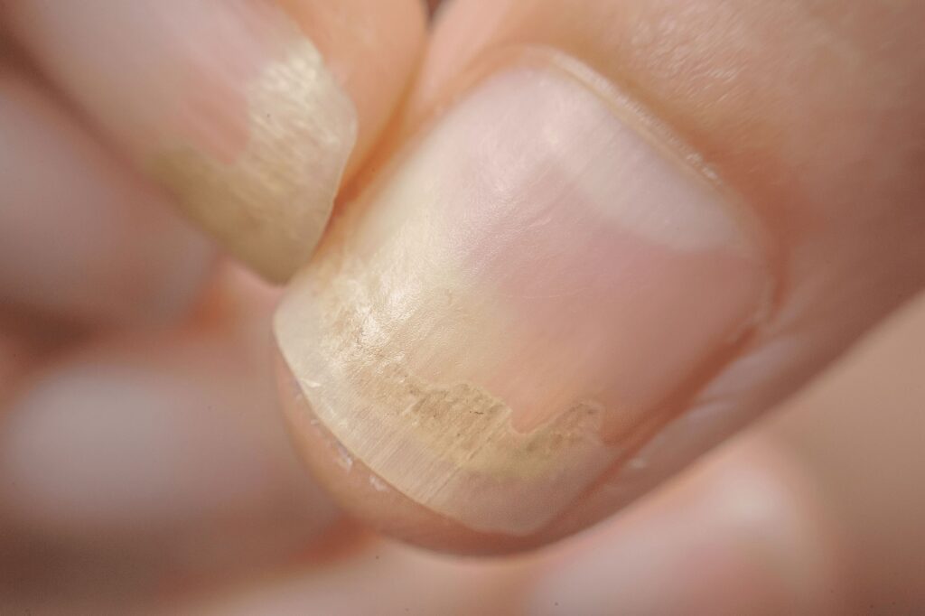 Nail Infections Caused By Fungi Such As: Onychomycosis Also Known