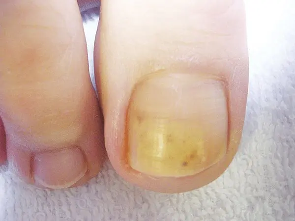 nail fungus, fungal infection on a toenail