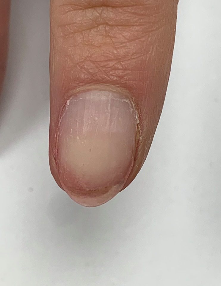 Black line on finger nail - Melanoma? Skin cancer? - Page: 4