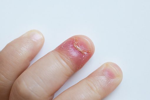 Paronychia, swollen finger with inflammation due to bacterial infection