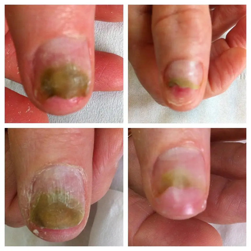 Chloronychia. green nail syndrome