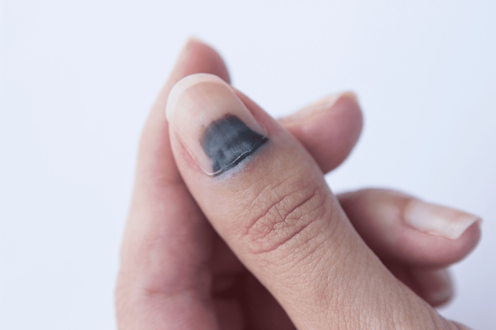 Bruised Nails - NailKnowledge