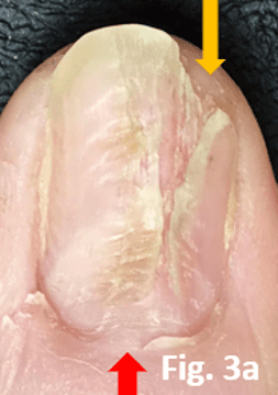 Lichen Planus showing how the nail bed and the nail plate no longer close off