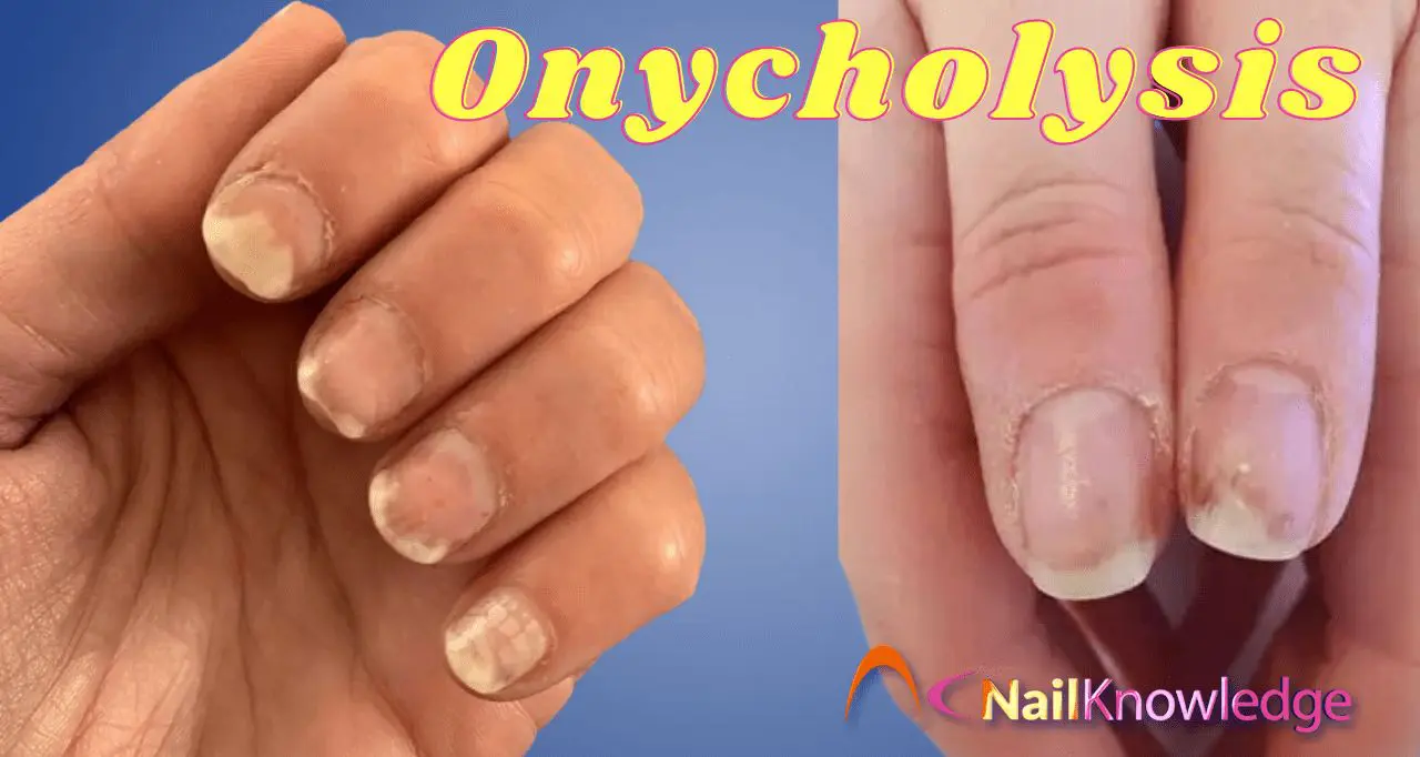 Onycholysis from nail coatings