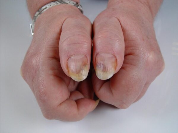 Splinter haemorrhages - NailKnowledge