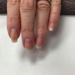 Splinter haemorrhages - NailKnowledge