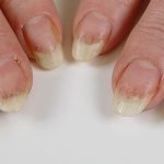 Splinter Hemo Splinter haemorrhages - NailKnowledge