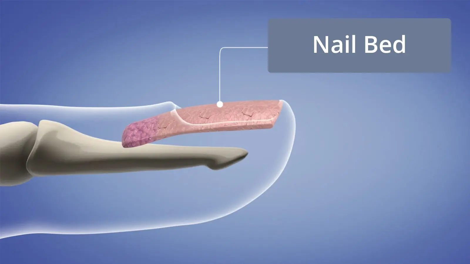 Onycholysis |Uuggghh I damaged my nail | Fixing my separated, damaged nail  - YouTube