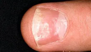 Psoríase