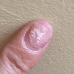 Damaged nail