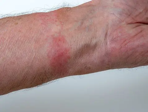 Dermatitis alérgica de contacto