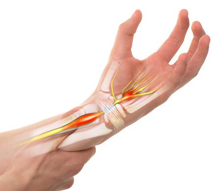 Carpal Tunnel Syndrome - Wrist Pain
