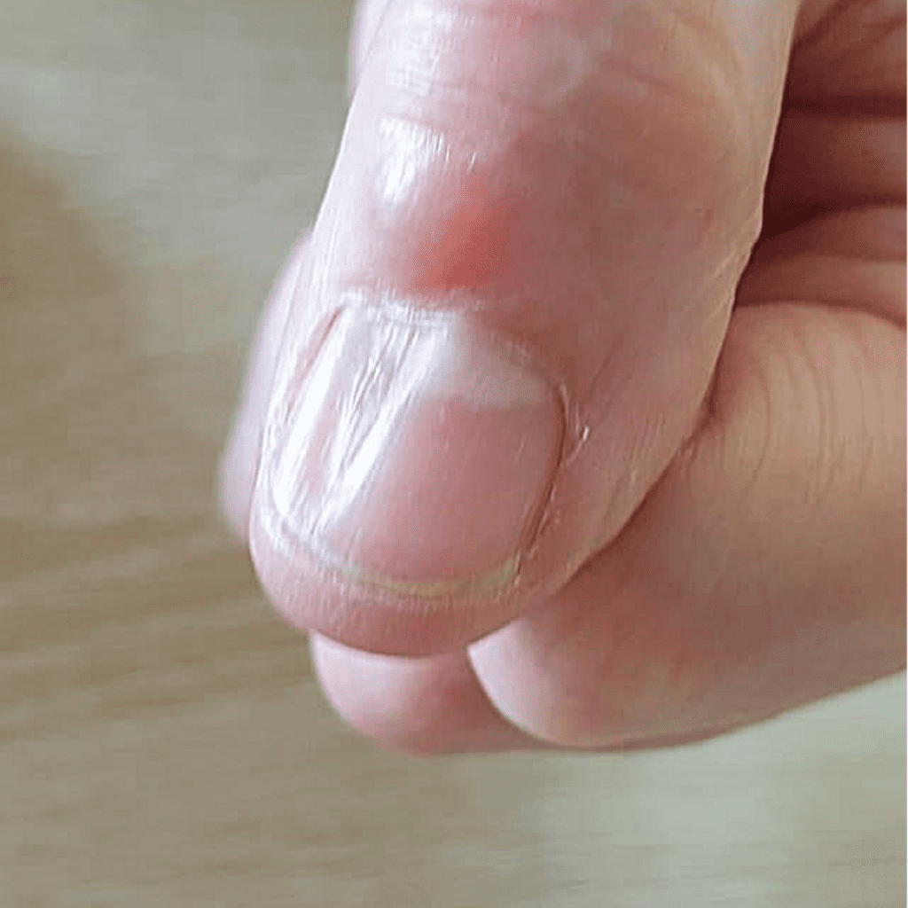 A) Yellowish, thickened nail plate of the right index finger, with... |  Download Scientific Diagram