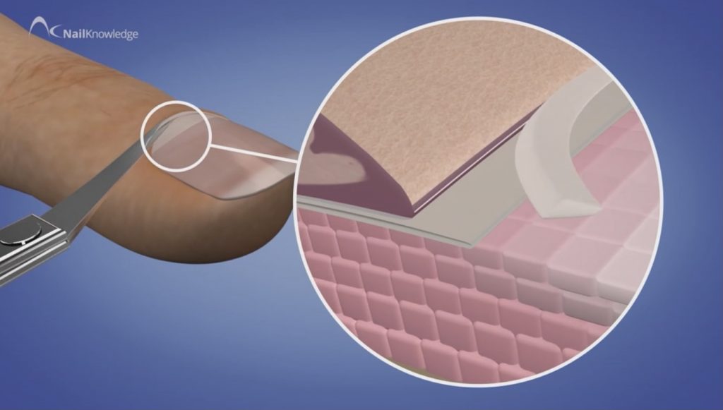 Breaking the seal by cutting the proximal nail fold