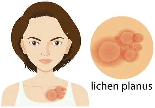 Diagram showing lichen planus on woman skin