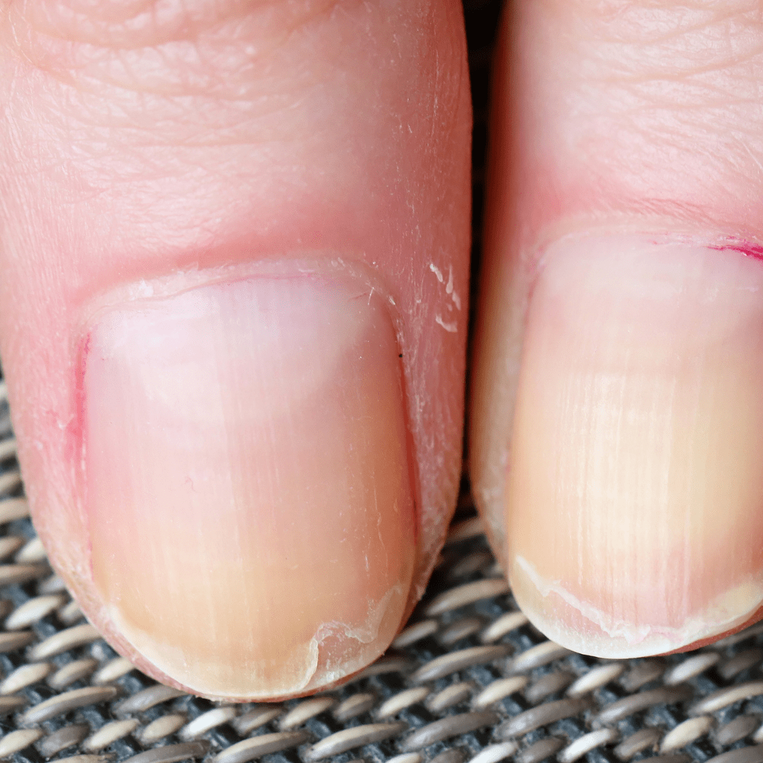 Share 133+ dry peeling nails causes latest - songngunhatanh.edu.vn