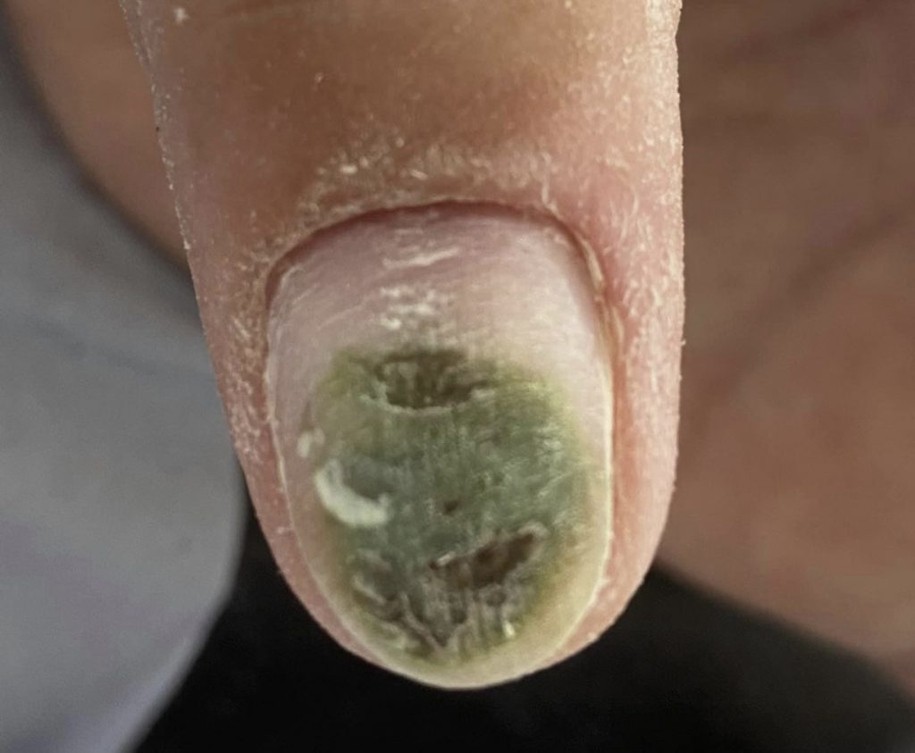 Cureus | Non-Melanoma-Associated Dyschromia of the Proximal Nail Fold |  Article