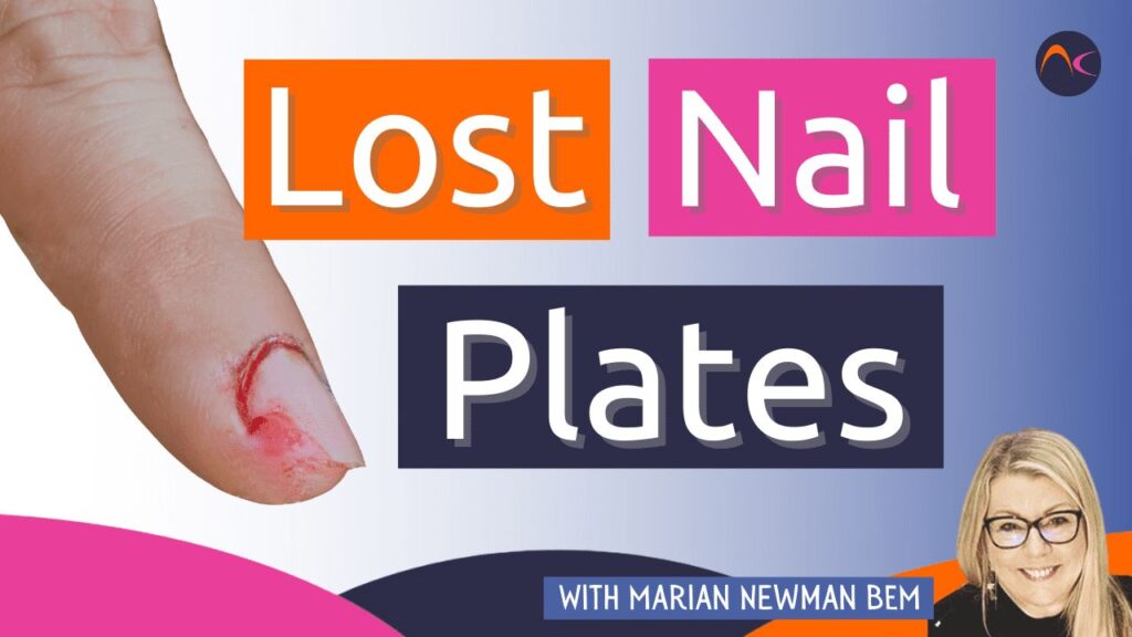 Lost nail plate