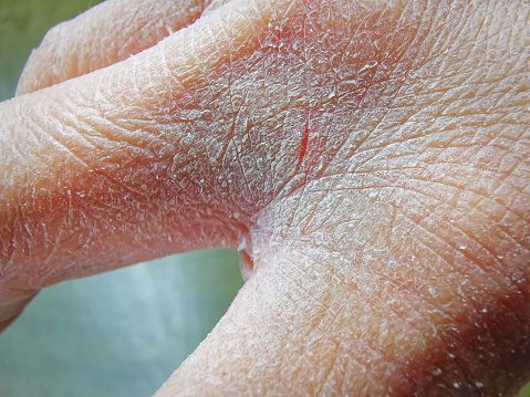 xerosis, very dry skin on hand