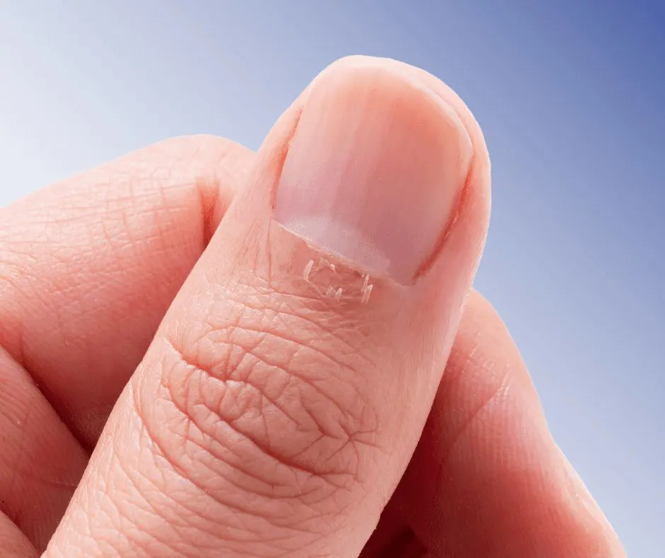 deep cut of the little finger on the leg, peeling of the nail and torn skin  on the finger. Stock Photo | Adobe Stock