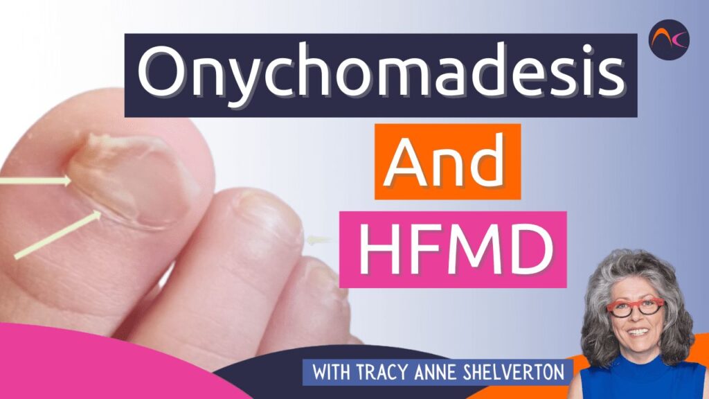 Hand Foot and Mouth Disease, Onychomadesis