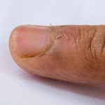 Hangnail Skin Infection