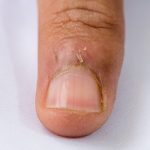 Hangnail Skin Infection