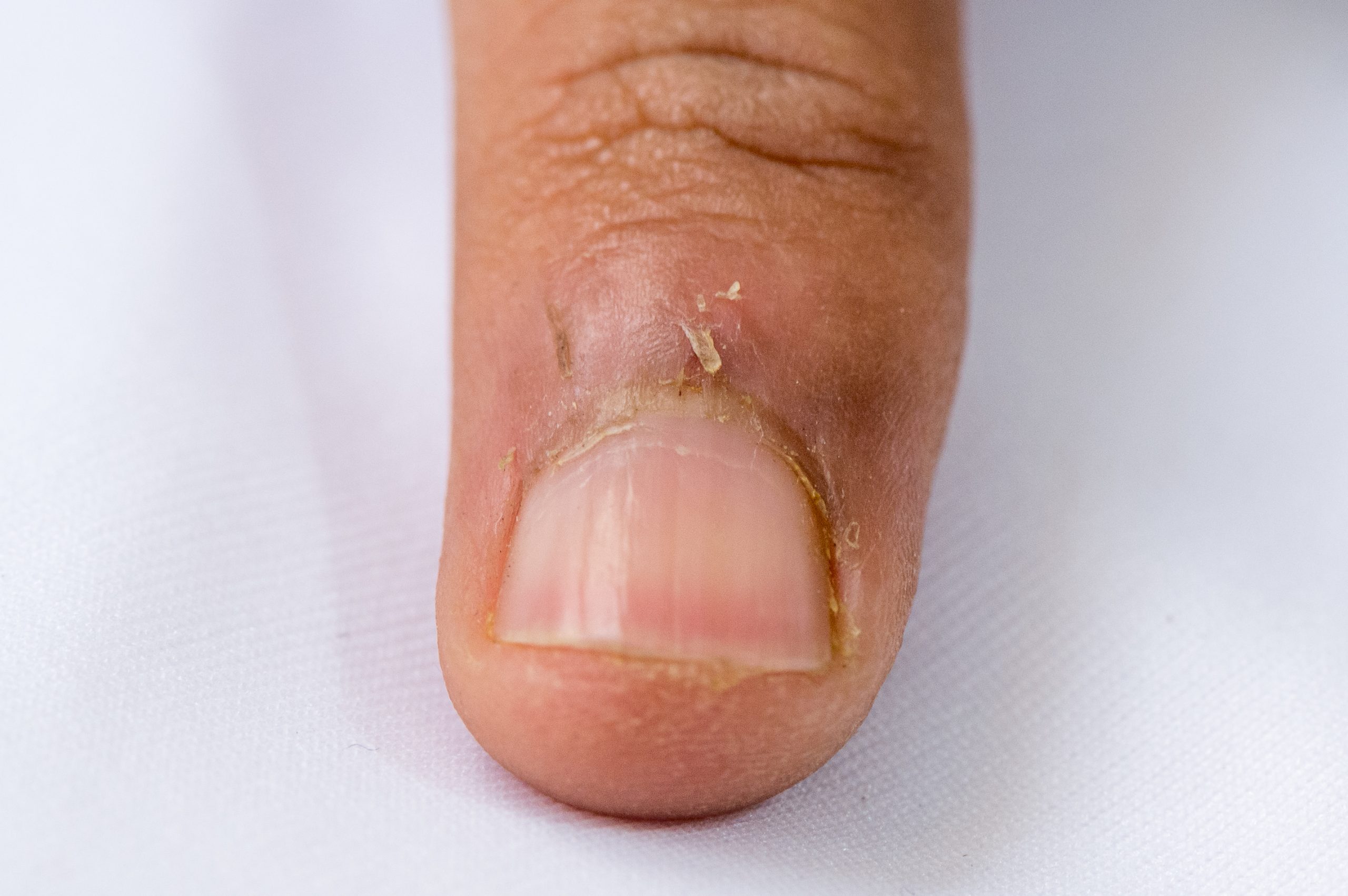 infected-hangnail-treatment-complications-and-when-to-see-a-doctor