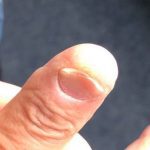 Koilonychia nail condition