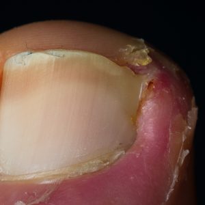 macro photo of an ingrown nail in the healing period
