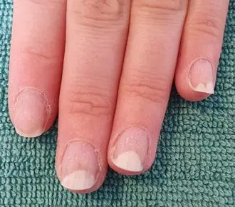 Onycholysis from nail coating
