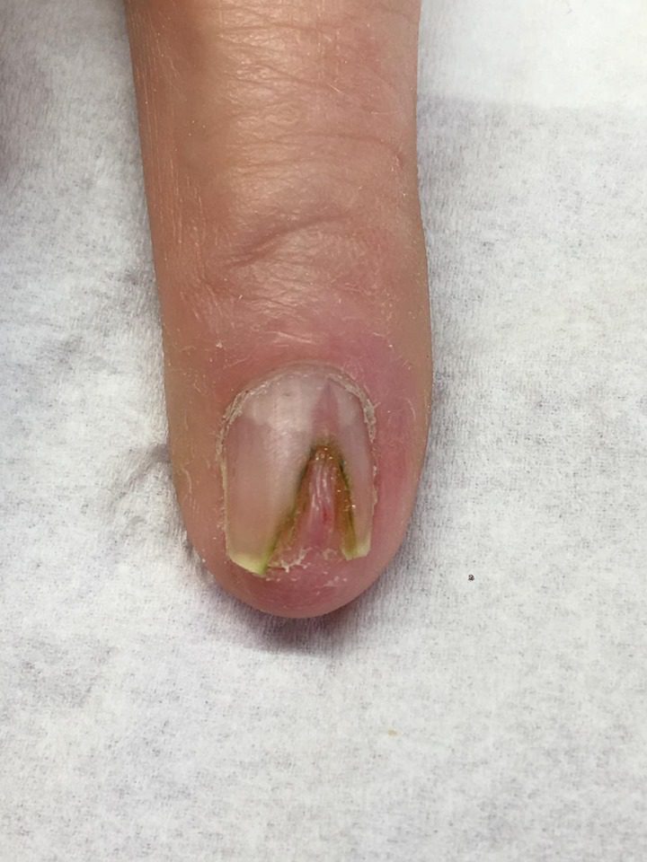 Doctor warns acrylic fake nails could turn nails green
