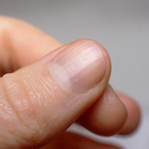 Vertical nail ridges