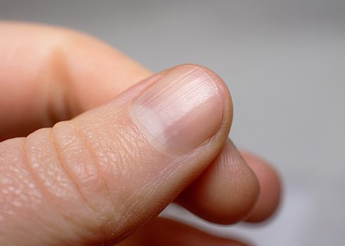 Why does a fingernail grow with indents parallel with the cuticle? - Quora