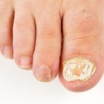 White superficial onychomycosis WOS