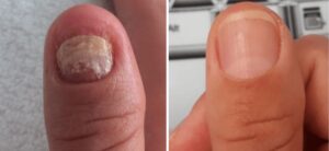 Before and after photos of confirmed and treated onychomycosis, taken 6 months apart.