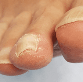 Ingrowing And Ingrown Nails - NailKnowledge