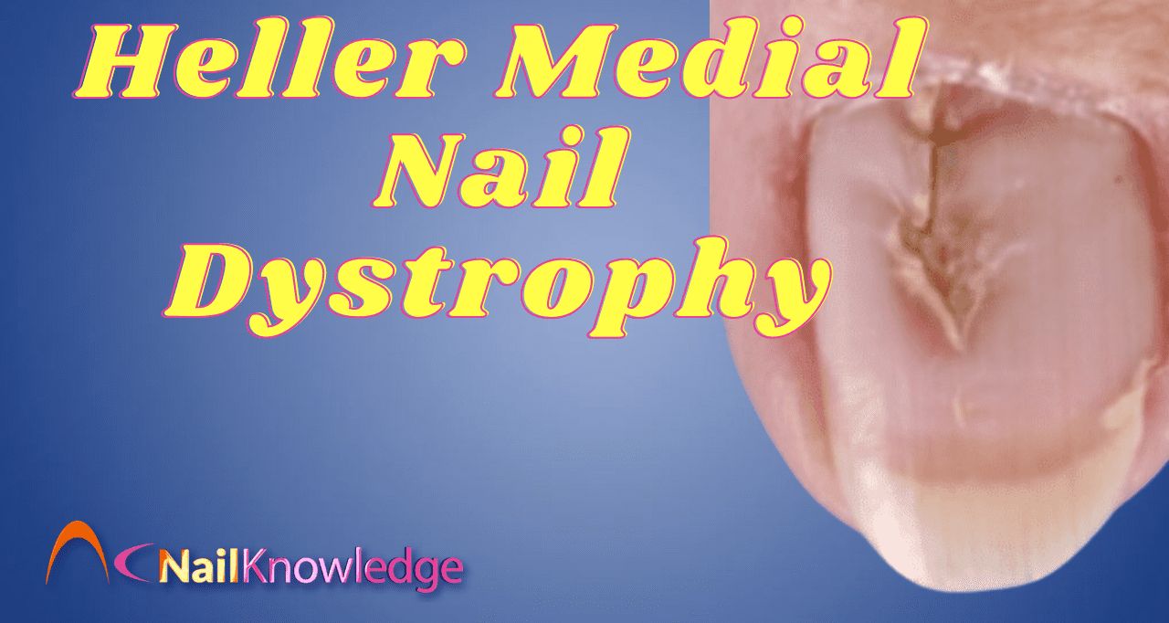 Solenonychia, or Heller's Median Nail Dystrophy (2)