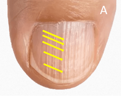 Open Beaded Ridge nail plate