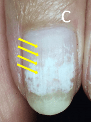 White superficial onychomycosis