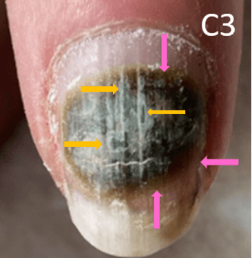 Pseudomonas Aeruginosa in porous nail plate