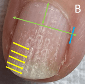 Open Beaded Ridge nail plate