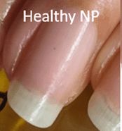 Healthy nail plate
