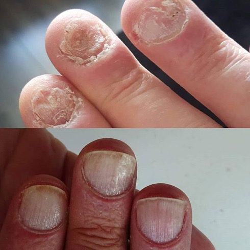 Nail biter nails, treated