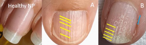 nail plate condition comparison