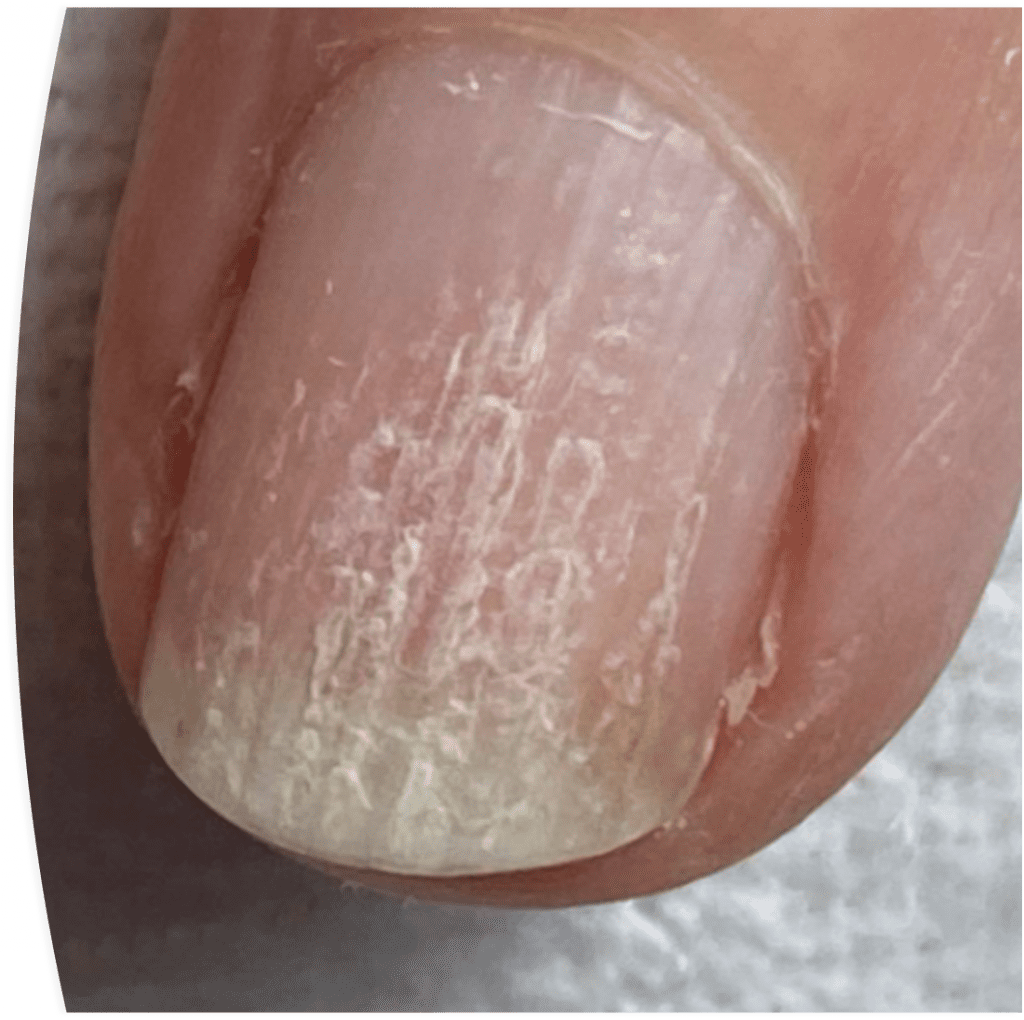 What ridges in your nails really mean – and when it's time to go doctors -  Daily Star