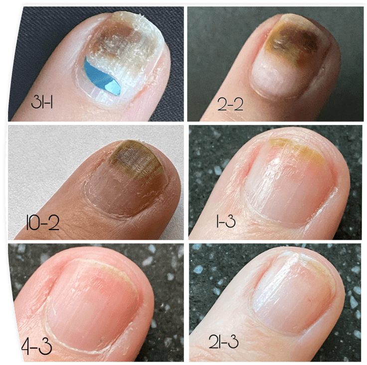 Pseudomonas Aeruginosa treatment on ridged nails