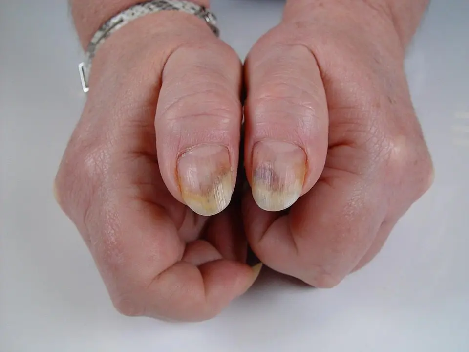 Can nail salons fix broken nails? - Quora