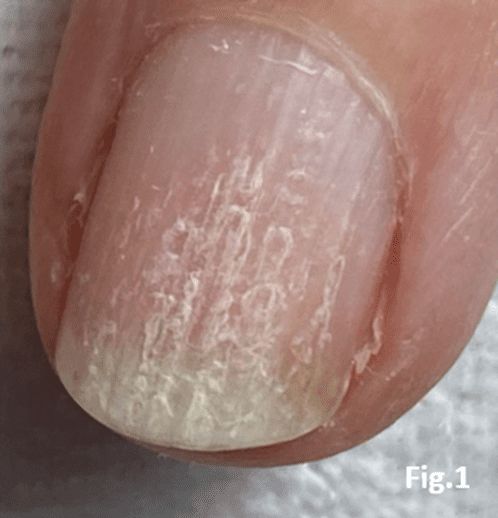 Beaded ridge nail plate - brittle nails