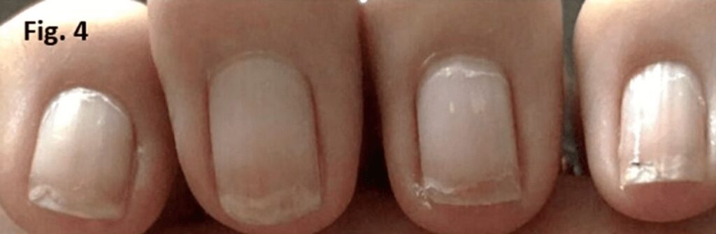 Onychoschizis of the nail plate - brittle nails
